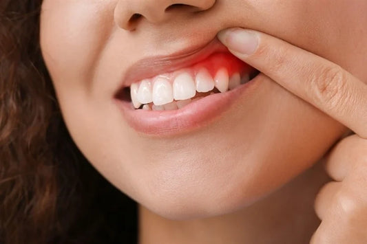 Gingivitis Treatment – Causes, Symptoms and Treatments