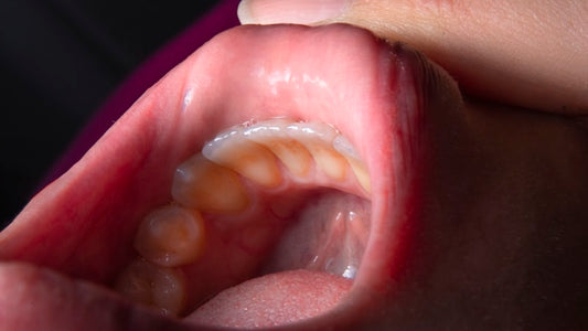 What Causes Canker Sores: The Truth About SLS - Health and wellness guide