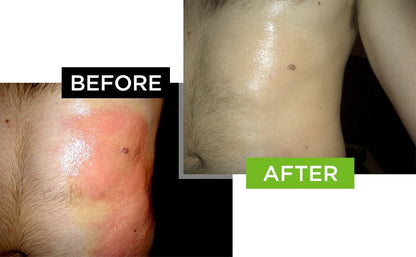 Scarderma Pro chemical burn