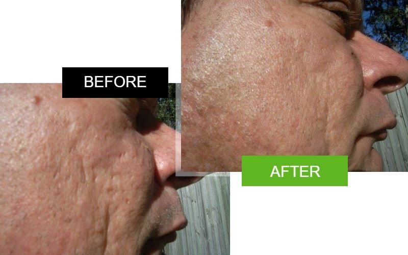 Sd7 Serum before and after 4