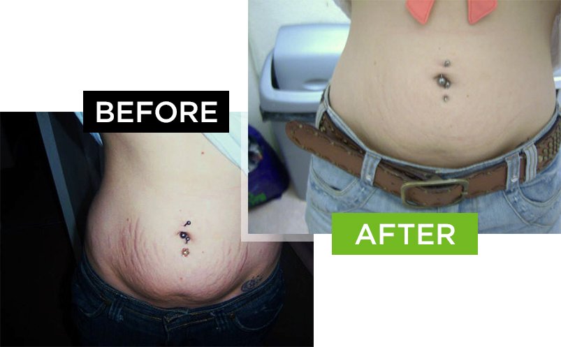 Scarderma Pro stretch marks