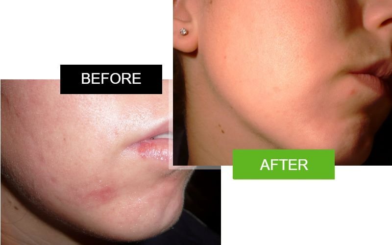 Scarderma Pro mouth scar