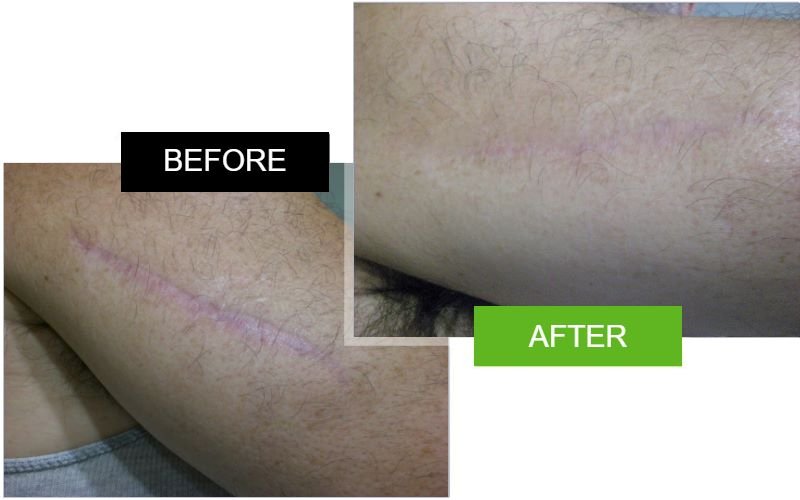 Scarderma Pro arm scar