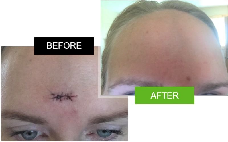 Scarderma Pro head scar