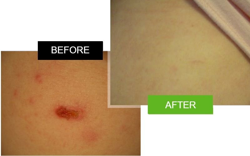 Scarderma Pro mole scar