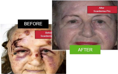 Scarderma Pro facial scar