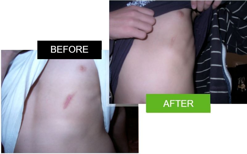 Scarderma Pro belly scar