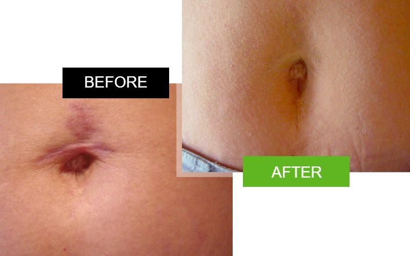 Scarderma Pro belly button scar