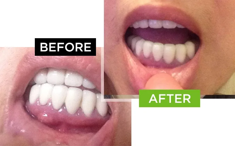 picture of red, puffy gums - before and after