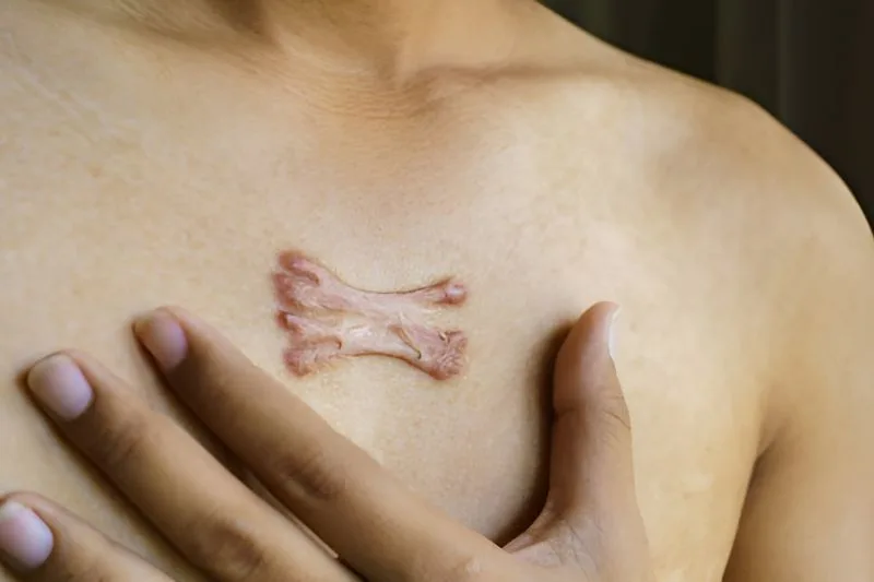 How to Soften Old Hard Scar Tissue with a Revolutionary Approach