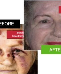 Scarderma Pro facial scar