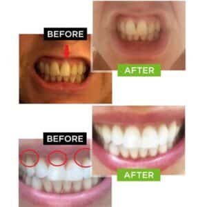 Dental Pro 7 - before and after 2