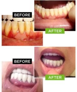 Dental Pro 7 - before and after 3