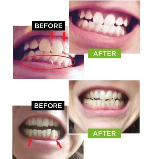 Dental Pro 7 - before and after