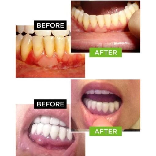 Dental Pro 7 - before and after 3