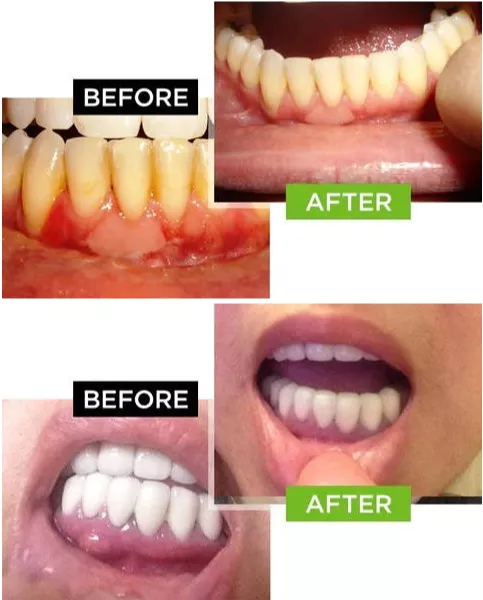 Dental Pro 7 - before and after
