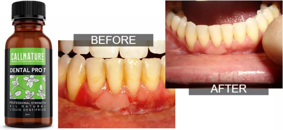 Dental Pro 7 with before and after pictures