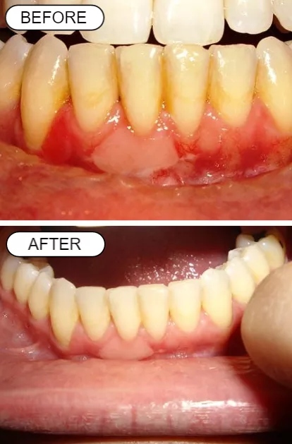 before and after using Dental Pro 7